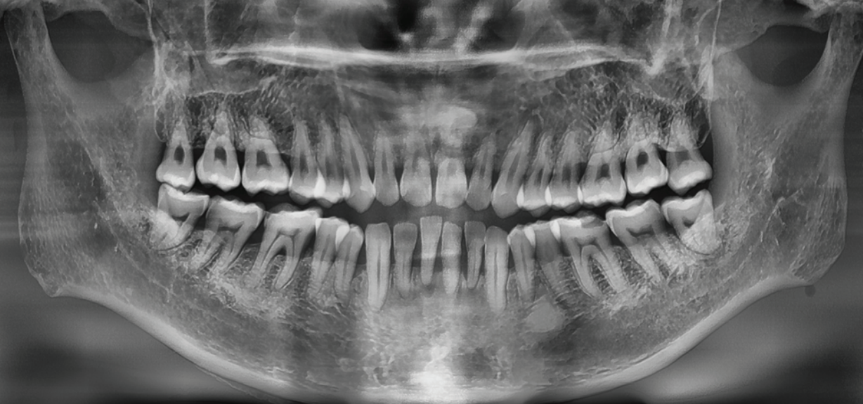 Panoramique dentaire A9 vatech